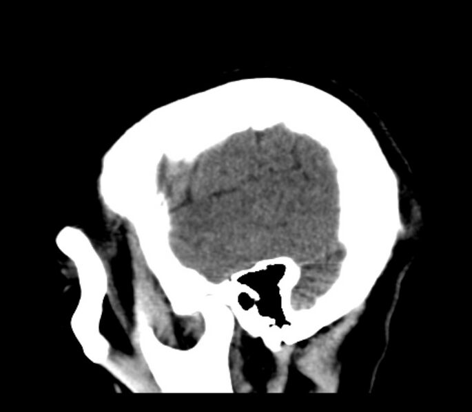 File:Chronic bilateral occipital lobe infarcts (Radiopaedia 31276-31996 C 34).jpg