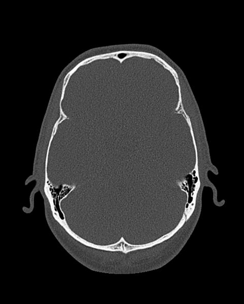 File:Chronic maxillary sinusitis caused by a foreign body (Radiopaedia 58521-65676 Axial bone window 301).jpg