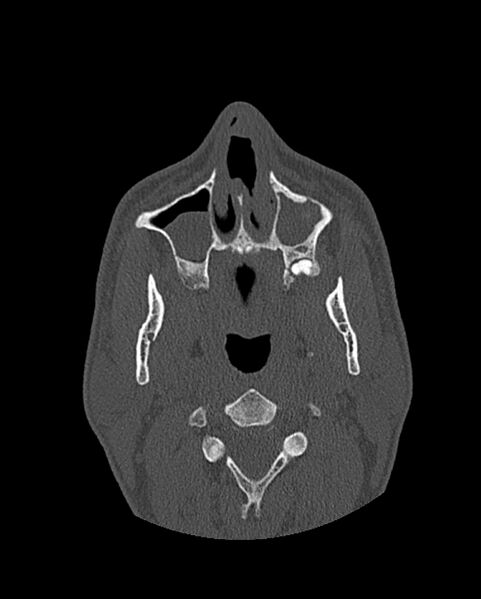 File:Chronic maxillary sinusitis caused by a foreign body (Radiopaedia 58521-65676 Axial bone window 73).jpg