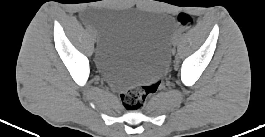 Chronic osteomyelitis (with sequestrum) (Radiopaedia 74813-85822 D 21).jpg