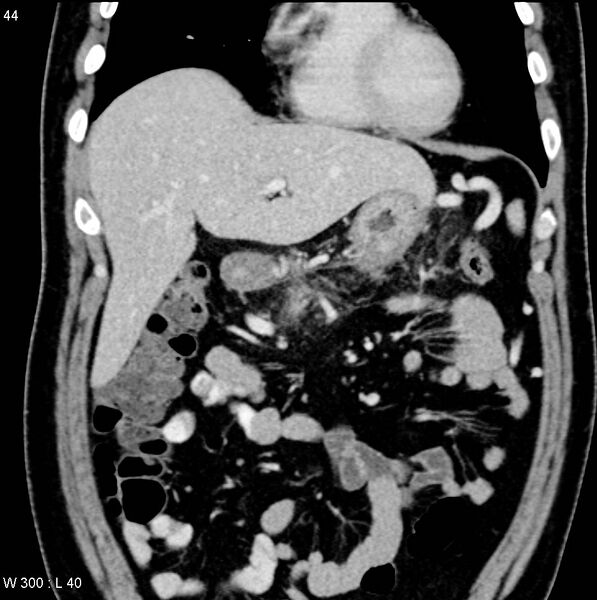 File:Chronic pancreatitis and pseudocysts (Radiopaedia 6724-7935 E 2).jpg