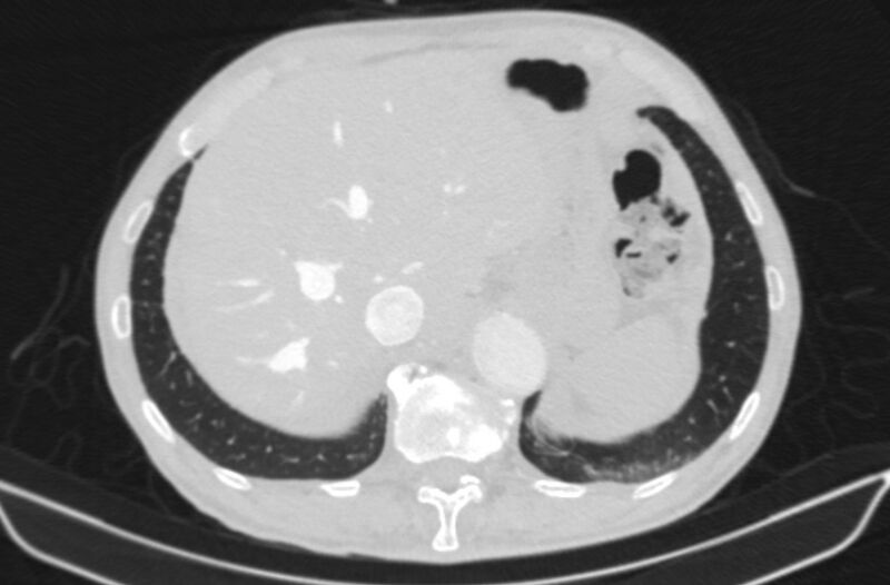 File:Chronic pulmonary embolism (Radiopaedia 91241-108843 Axial lung window 85).jpg