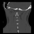 Clay-shoveler fracture (Radiopaedia 22568-22590 Coronal bone window 34).jpg