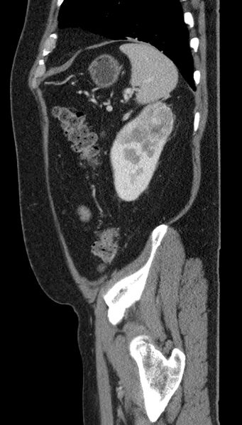 File:Clear cell renal cell carcinoma (Radiopaedia 61449-69393 G 12).jpg