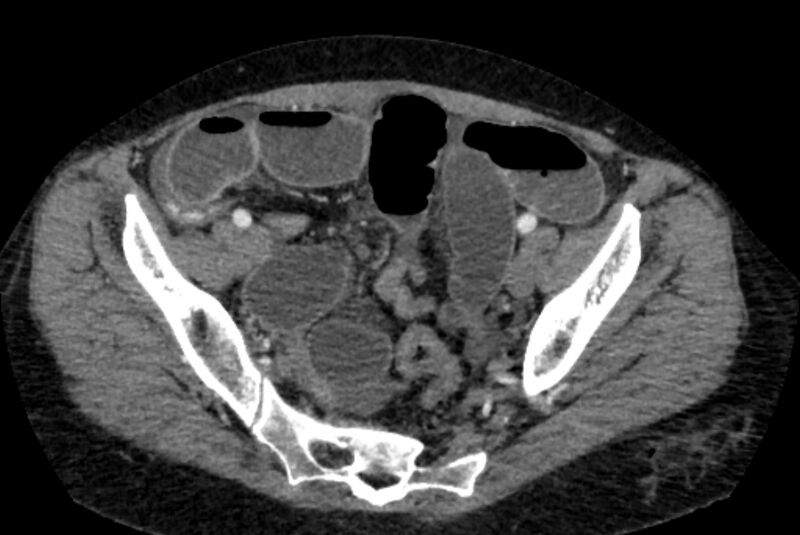 File:Closed loop small bowel obstruction (Radiopaedia 71211-81508 A 130).jpg