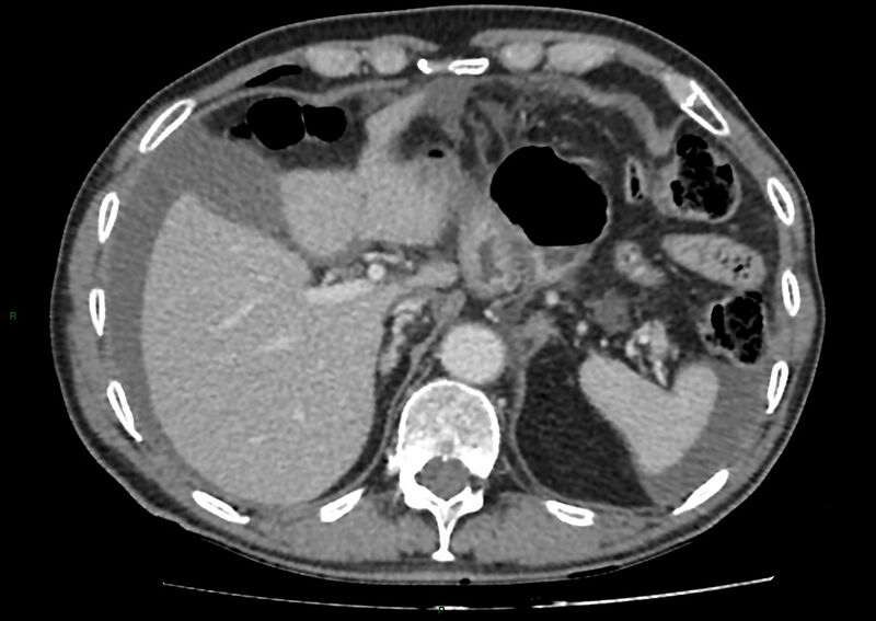 File:Closed loop small bowel obstruction with ischemia (Radiopaedia 84180-99456 A 24).jpg