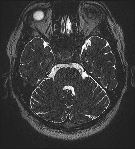 File:Cochlear incomplete partition type III associated with hypothalamic hamartoma (Radiopaedia 88756-105498 Axial T2 103).jpg