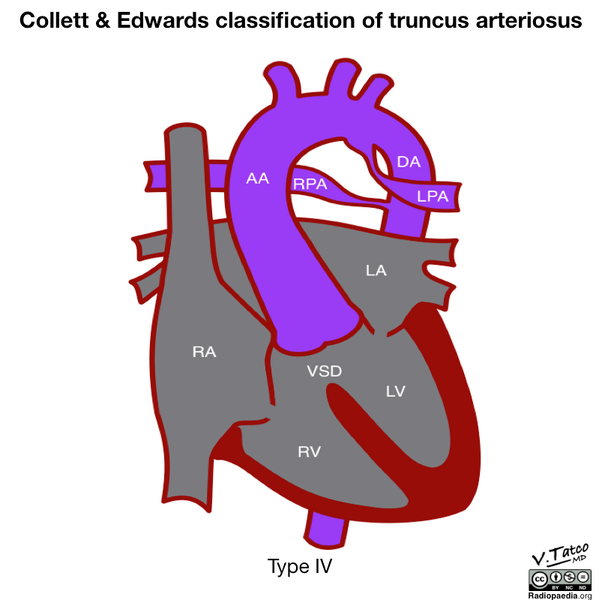 File:Collett and Edwards classification of truncus arteriosus (diagram) (Radiopaedia 51895-57733 E 1).png