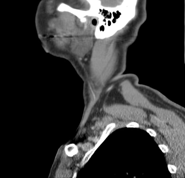 File:Colloid cyst of thyroid (Radiopaedia 22897-22923 Sagittal C+ delayed 10).jpg