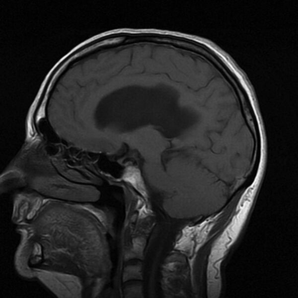 File:Colloid cyst with hydrocephalus (Radiopaedia 9373-10065 Sagittal T1 8).jpg