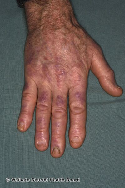 File:Gottron papules in dermatomyositis (DermNet NZ gottron-papules-dermatomyositis).jpg