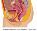Interstitial pregnancy (illustration) (Radiopaedia 73733).PNG