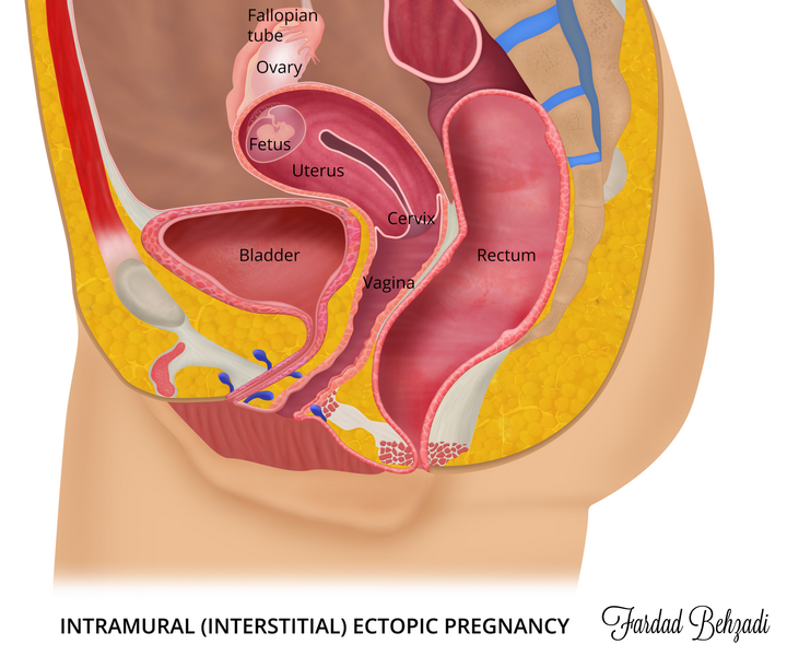 File:Interstitial pregnancy (illustration) (Radiopaedia 73733).PNG