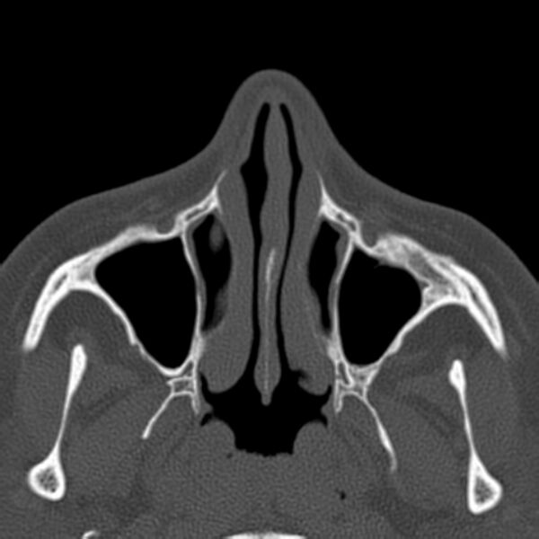 File:Nasolabial cyst (Radiopaedia 33987-35205 Axial bone window 15).jpg