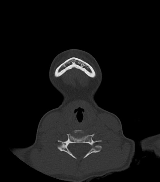 File:Nasoorbitoethmoid fracture (Radiopaedia 90044-107205 Axial bone window 14).jpg