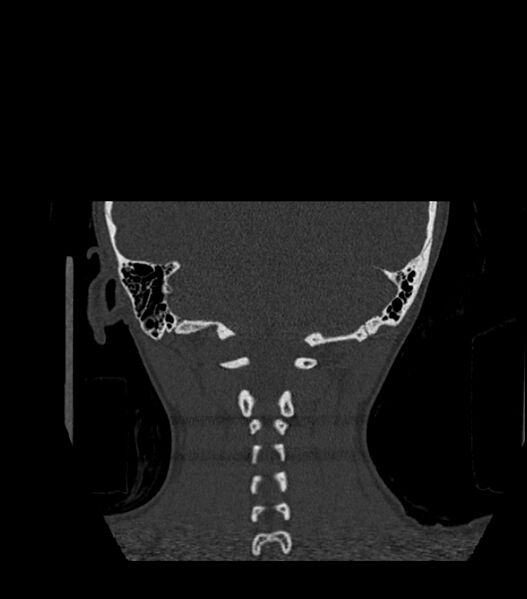 File:Nasoorbitoethmoid fracture (Radiopaedia 90044-107205 Coronal bone window 121).jpg