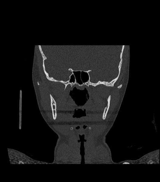 File:Nasoorbitoethmoid fracture (Radiopaedia 90044-107205 Coronal bone window 76).jpg