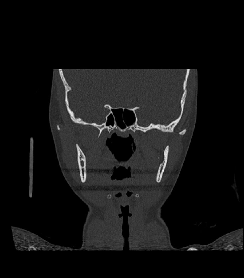 Nasoorbitoethmoid fracture (Radiopaedia 90044-107205 Coronal bone window 76).jpg