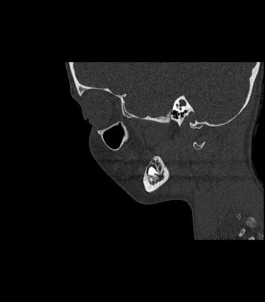 File:Nasoorbitoethmoid fracture (Radiopaedia 90044-107205 Sagittal bone window 44).jpg