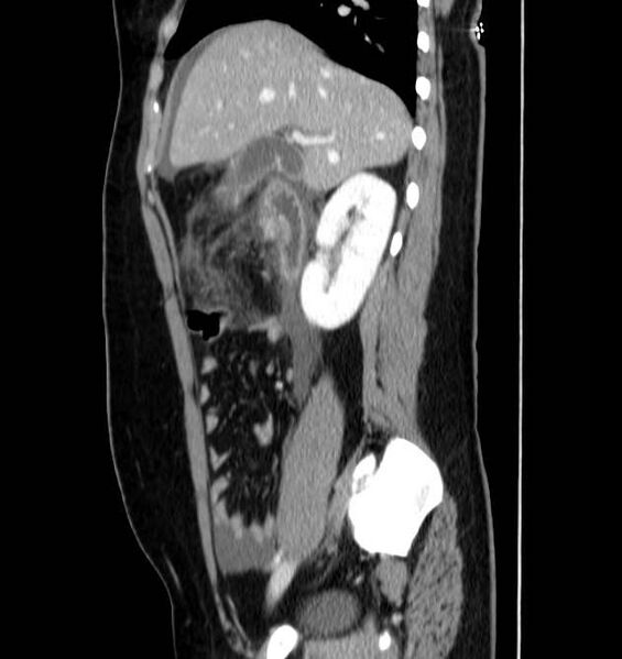 File:Necrotizing pancreatitis (Radiopaedia 23001-23031 C 22).jpg