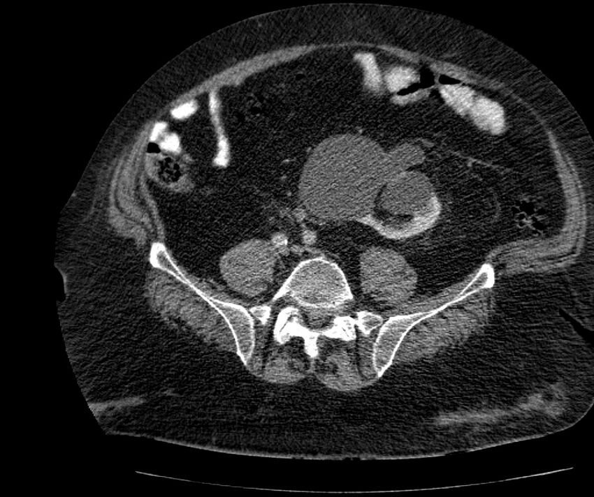 Nephroptosis with inguinal hernia containing perirenal fat (Radiopaedia 56632-63391 C 238).jpg