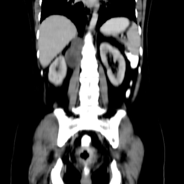 File:Neurofibroma - spine (Radiopaedia 27891-28125 B 20).jpg