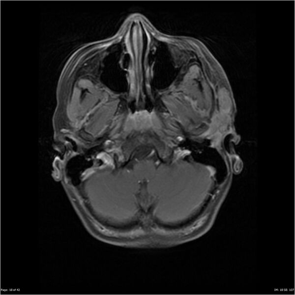 File:Neurofibromatosis type 1 (Radiopaedia 22541-22564 Axial T1 C+ fat sat 18).jpg