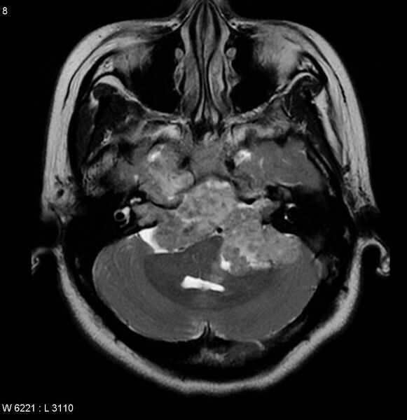 File:Neurofibromatosis type 2 - cranial and spinal involvement (Radiopaedia 5351-7111 Axial T2 5).jpg