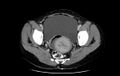Non-puerperal uterine inversion (Radiopaedia 78343-91094 A 40).jpg