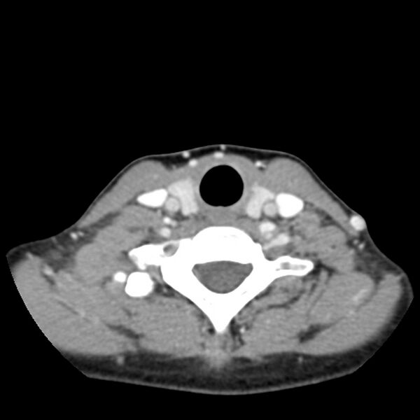 File:Normal CT of the neck (Radiopaedia 14575-14500 Axial C+ 51).jpg