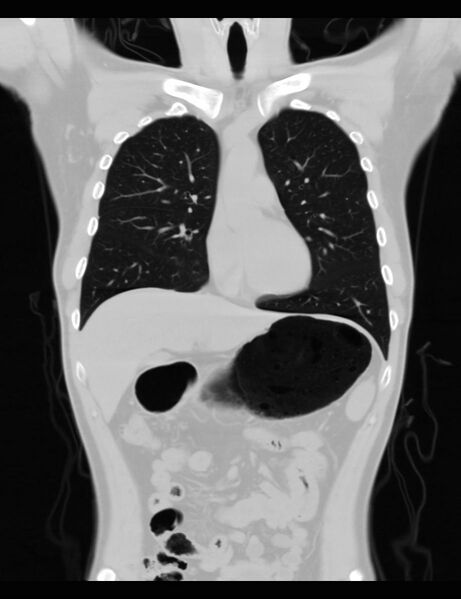 File:Normal CT virtual gastroscopy (Radiopaedia 29960-30501 F 12).jpg