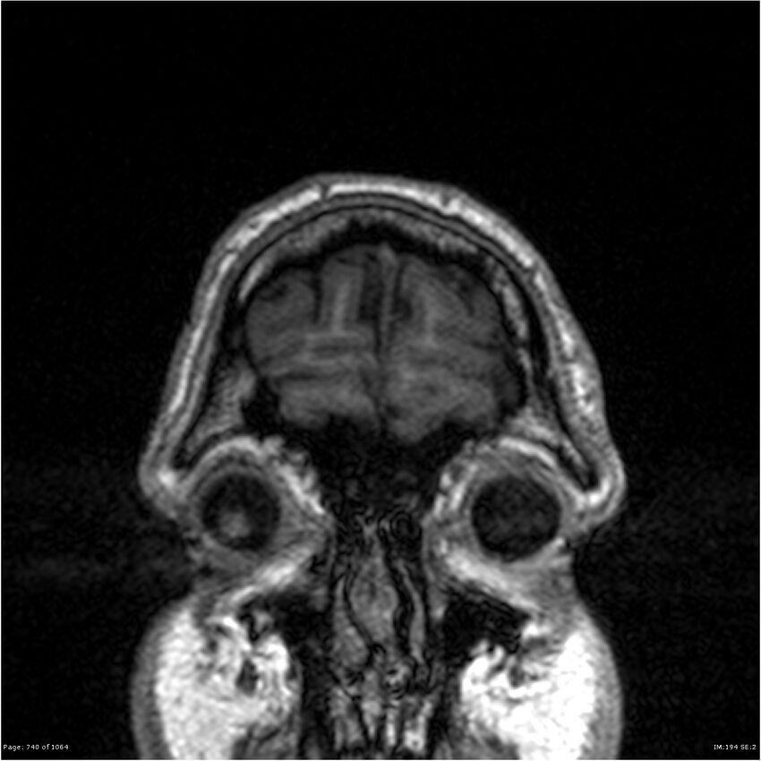 Normal brain MRI (non-focal epilepsy protocol) (Radiopaedia 38571-40700 Coronal T1 96).jpg
