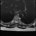 Normal cervical and thoracic spine MRI (Radiopaedia 35630-37156 H 29).png