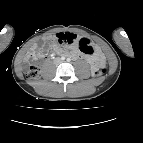 File:Normal dual-phase trauma CT chest,abdomen and pelvis (Radiopaedia 48092-52899 A 80).jpg