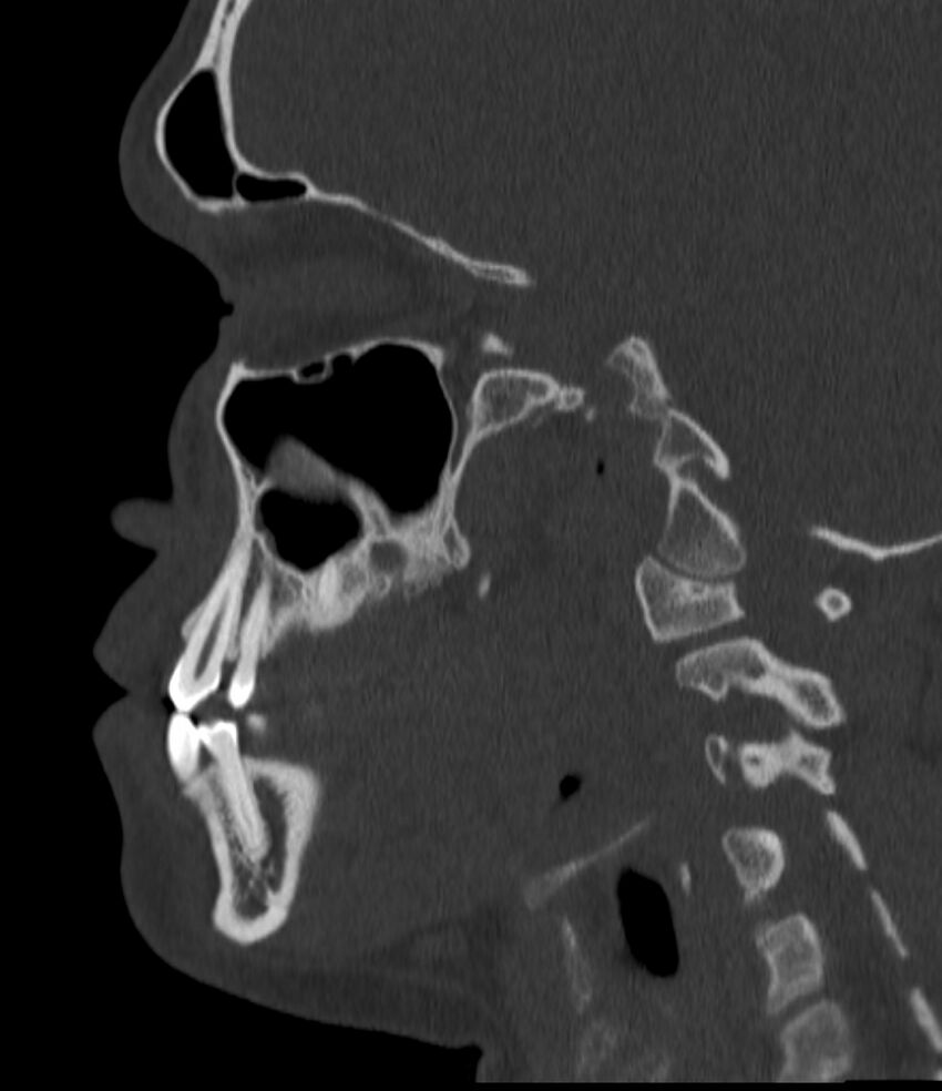 Normal facial bone CT (Radiopaedia 88742-105476 Sagittal bone window 103).jpg