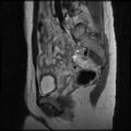 Normal female pelvis MRI (retroverted uterus) (Radiopaedia 61832-69933 Sagittal T2 12).jpg