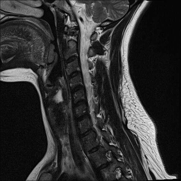 File:Normal trauma cervical spine MRI (Radiopaedia 32130-33071 Sagittal T2 5).jpg