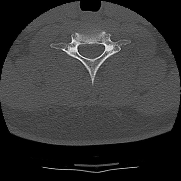 File:Normal trauma spine imaging (Radiopaedia 31753-32686 Axial bone window 64).jpg