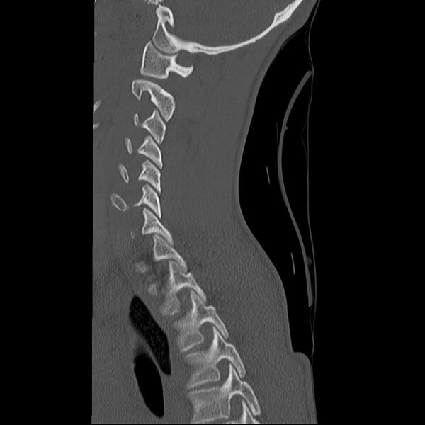 File:Normal trauma spine imaging (age 16) (Radiopaedia 45335-49358 Sagittal bone window 11).jpg
