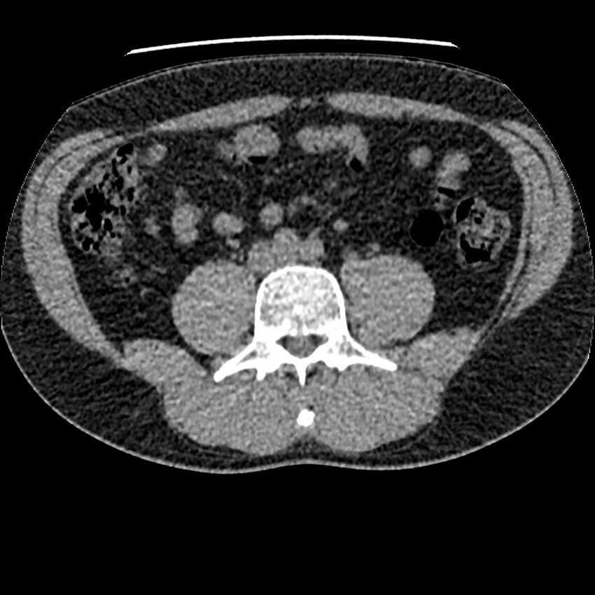 Obstructing ureteric calculus and ureteric anatomy (Radiopaedia 62730-71042 Axial non-contrast 83).jpg