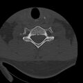 Occipital condyle fracture (Radiopaedia 31755-32691 Axial bone window 58).jpg