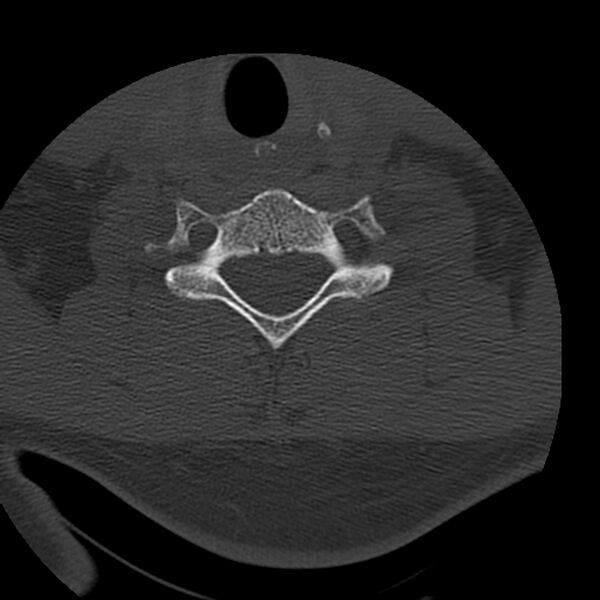 File:Occipital condyle fracture (Radiopaedia 31755-32691 Axial bone window 58).jpg