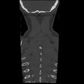 Occipital condyle fracture (Radiopaedia 31755-32691 Coronal bone window 37).jpg