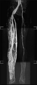 MRI-dilated turtuous blood vessels