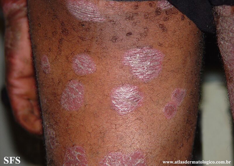 File:Psoriasis (Dermatology Atlas 113).jpg
