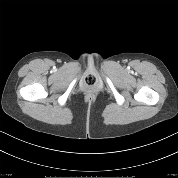 File:Traumatic renal artery dissection and pancreatic transection (Radiopaedia 37061-38739 Axial 290).jpg