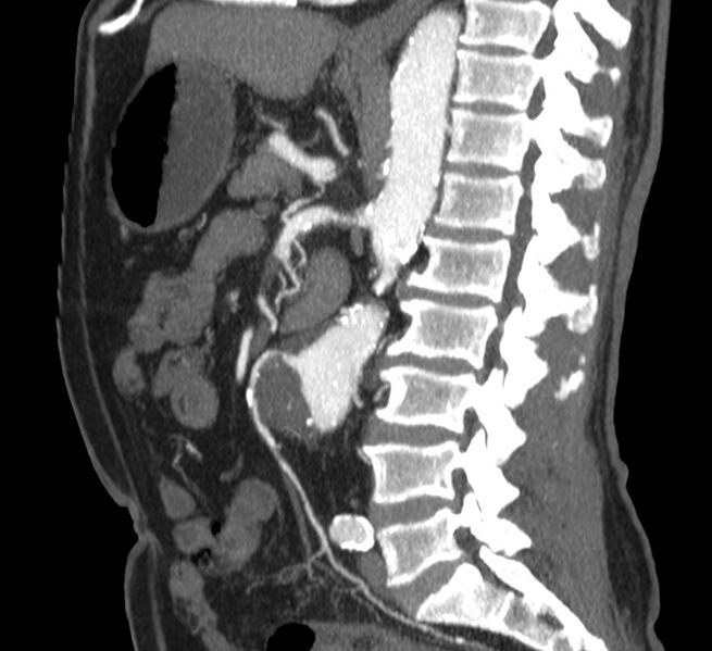 File:Abdominal aortic aneurysm (Radiopaedia 22421-22458 D 22).jpg
