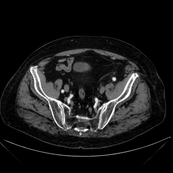File:Abdominal aortic aneurysm (Radiopaedia 25855-26001 Axial C+ arterial phase 110).jpg