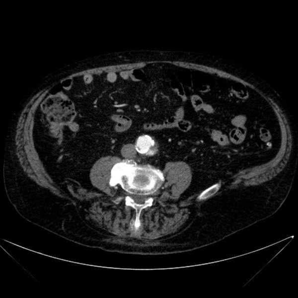 File:Abdominal aortic aneurysm (Radiopaedia 25855-26001 Axial C+ arterial phase 83).jpg