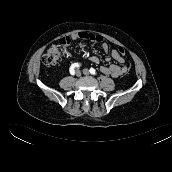 File:Abdominal aortic aneurysm (Radiopaedia 75131-86203 Axial C+ arterial phase 30).jpg